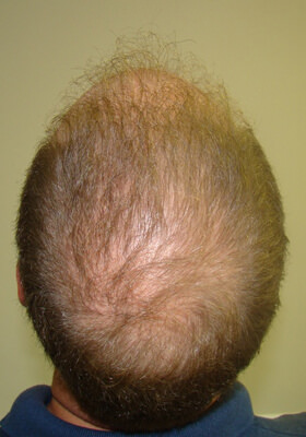 hair transplant photos