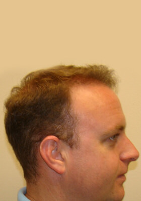 hair transplant photos