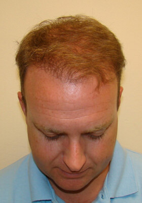 hair transplant photos