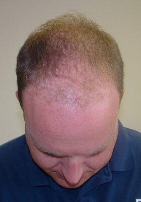 hair transplant photos