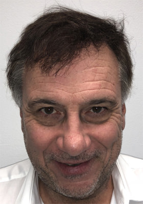 hair transplant before after Photos