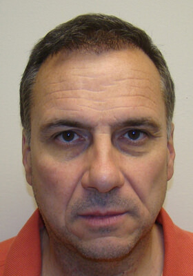 hair transplant photos