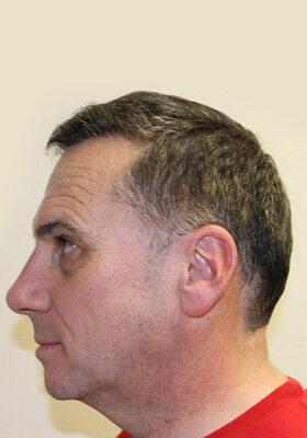 hair transplant photos