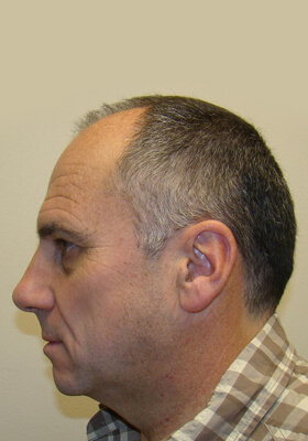 hair transplant photos