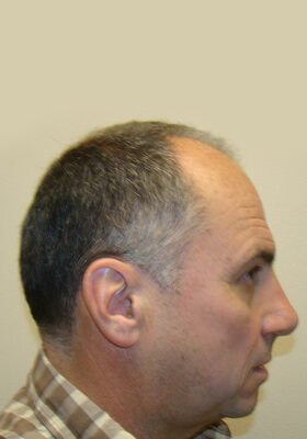 hair transplant photos