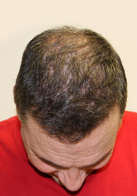 hair transplant photos