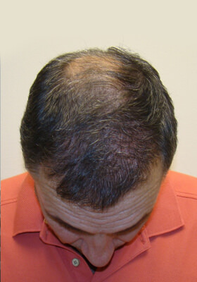 hair transplant before after Photos