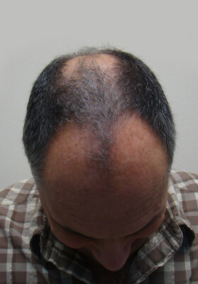 hair transplant photos