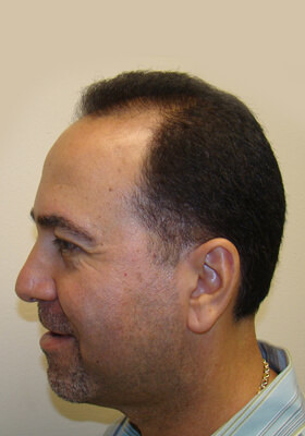 hair transplant photos