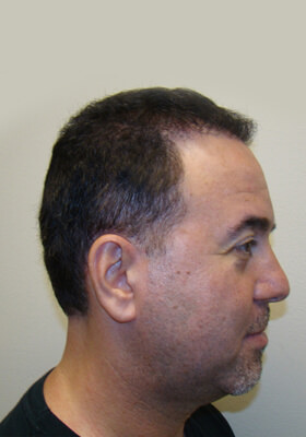 hair transplant photos