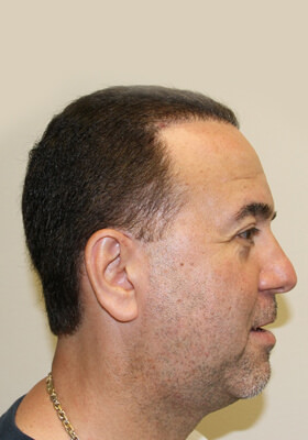 hair transplant photos