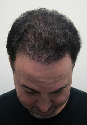 hair transplant photos