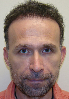 hair transplant photos