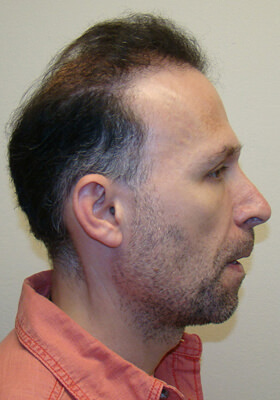 hair transplant photos