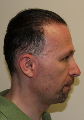 hair transplant photos