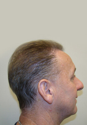 hair transplant before after Photos