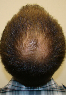 hair transplant photos