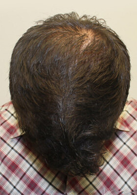 hair transplant photos