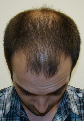 hair transplant before after Photos