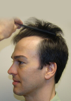 hair transplant photos