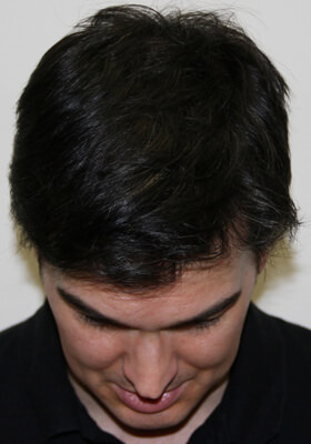 hair transplant photos