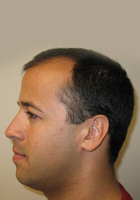 hair transplant photos