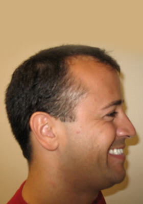 hair transplant photos