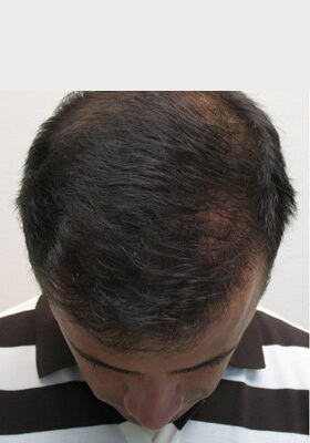 hair transplant before after Photos