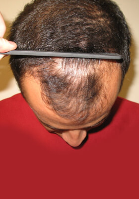 hair transplant before after Photos