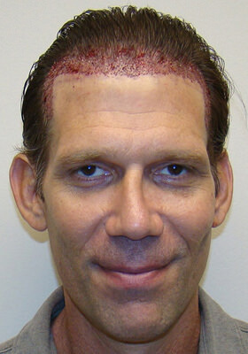 hair transplant photos