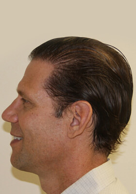 hair transplant photos