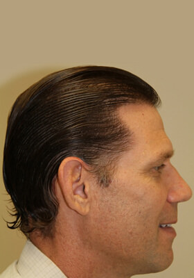 hair transplant photos