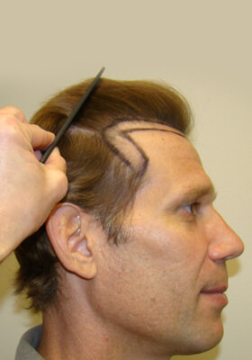 hair transplant photos