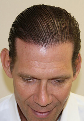 hair transplant photos