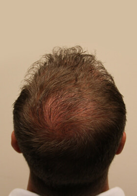 hair transplant photos