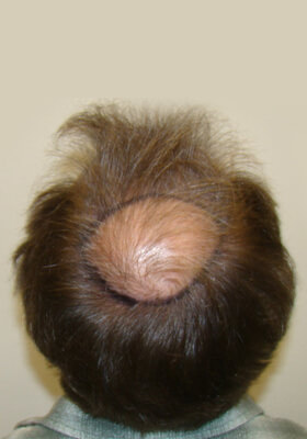 hair transplant photos