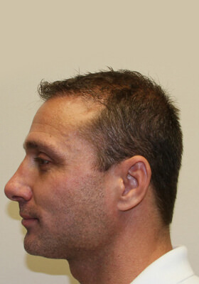 hair transplant photos