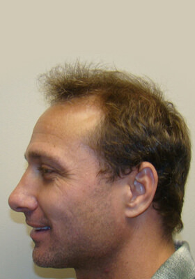 hair transplant photos