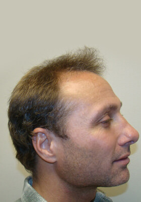 hair transplant photos