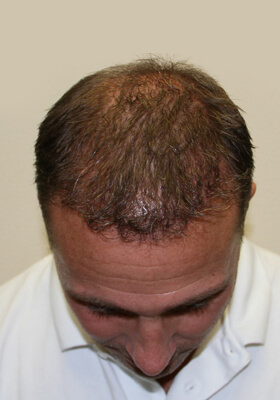 hair transplant photos