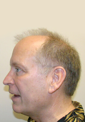 hair transplant before after Photos