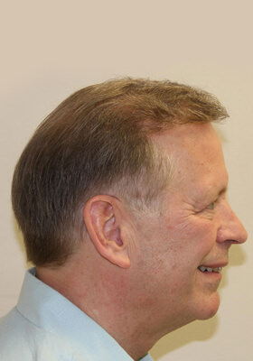 hair transplant photos