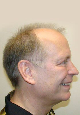 hair transplant photos