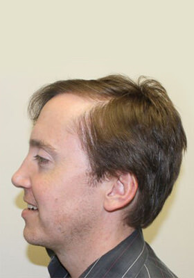 hair transplant photos