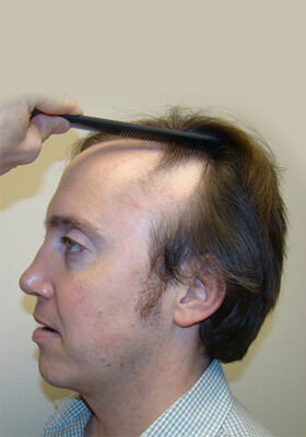 hair transplant photos