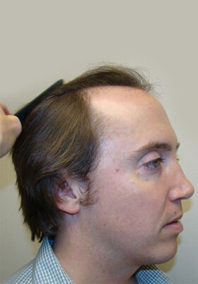 hair transplant photos