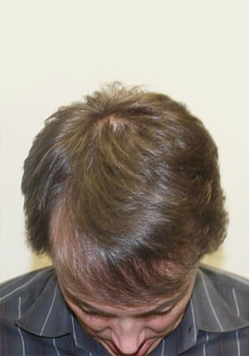 hair transplant before after Photos