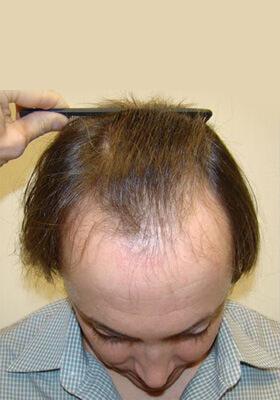 hair transplant photos