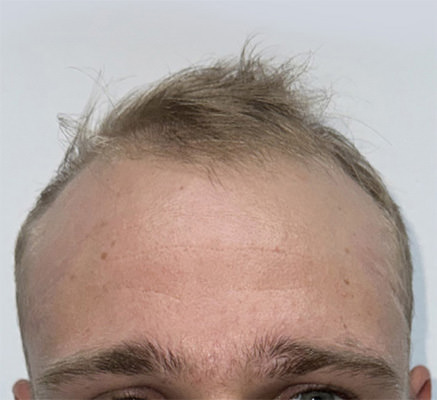 hair transplant photos