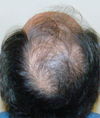 hair transplant photos